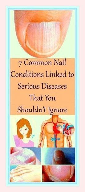 7 Common Nail Conditions Linked To Serious Diseases