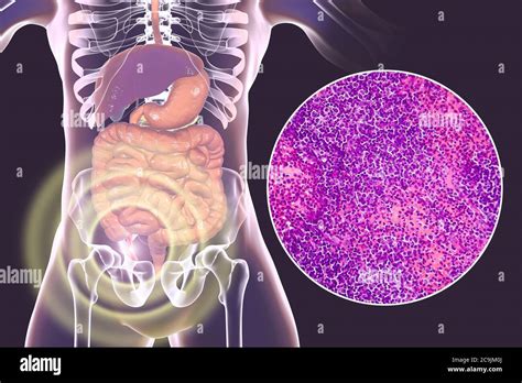 Apendicitis Supurativa Aguda Ilustración Por Ordenador Y Micrografía Ligera Ilustración De Un