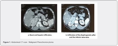 Management Of A Recurrent Malignant Pheochromocytoma A Case Report And Review Of Literature