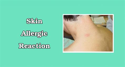 Skin Allergic Reaction: Reasons, Symptoms and best ways to treatment