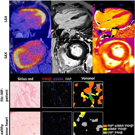 PDF Assessment Of Myocardial Fibrosis In Patients With Systemic