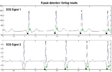 Figure From Nm Asic Implementation Of Qrs Detector Based On Pan