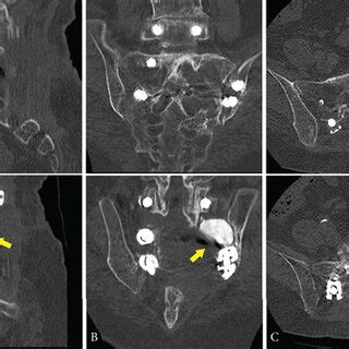 As Of 10 Months After The Surgery Computed Tomography Shows No