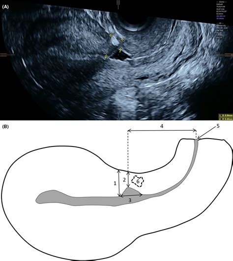 Ultrasound Cesarean Scar Assessment One Year Postpartum In Relation To