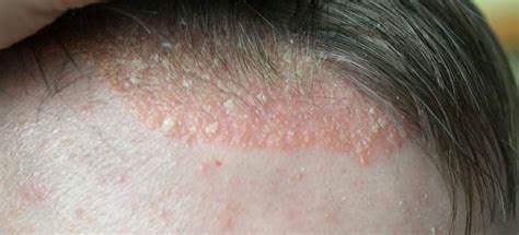 how to treat seborrheic dermatitis - pictures, photos