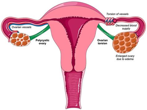 Biomedicines Free Full Text Ovarian Torsion In Polycystic Ovary