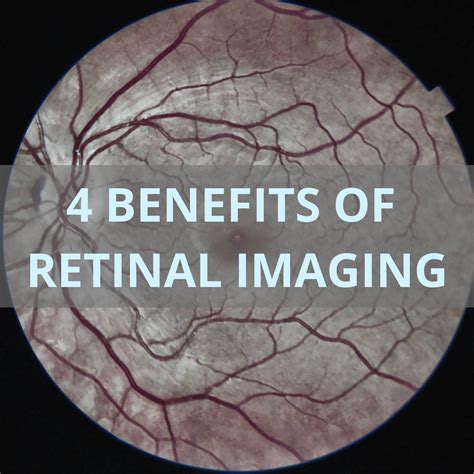 4 Benefits Of Retinal Imaging Iris