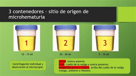 Interpretación de un Examen Elemental de Orina YouTube