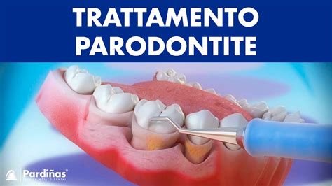 Trattamento Parodontite Curettage E Sondaggio Parodontale Youtube