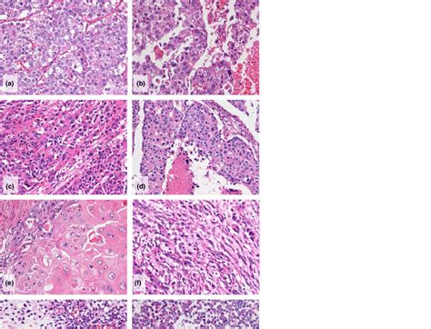 Histological Presentation Of Triple Negative Breast Cancers That Showed