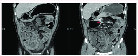 Contrast Enhanced Computed Tomography Of The Abdomen And Pelvis