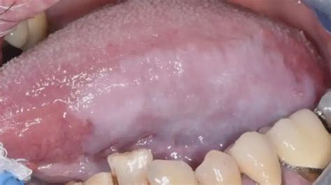 Leukoplakia From Early Diagnosis To Its Treatment