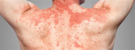 Skin Allergy - Symptoms, Causes And Treatment