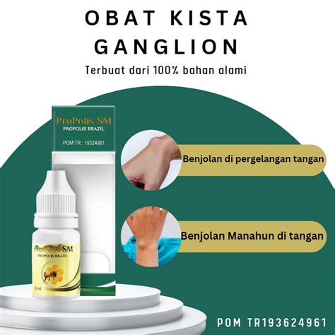 Jual Kaka Herbal Obat Penghancur Kista Ganglion Obat Kista Ganglion