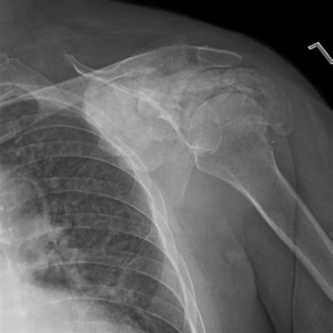 Left Shoulder X Ray During Admission Download Scientific Diagram