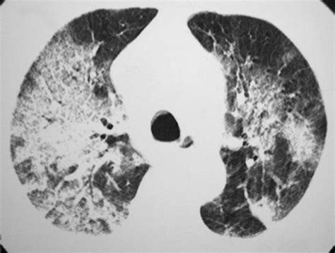 Hrct Showing Extensive Areas Of Consolidation With Air Bronchogram And Download Scientific