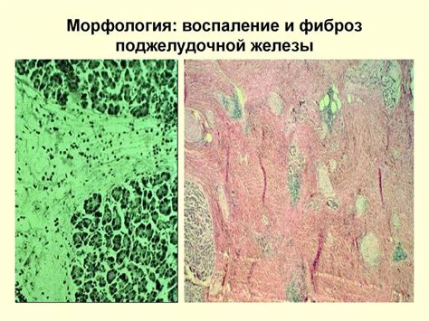 Фиброз и фибролипоматоз поджелудочной, симптомы и лечение