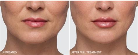 Juvederm Filler Dr Chernoff Plastic Surgery