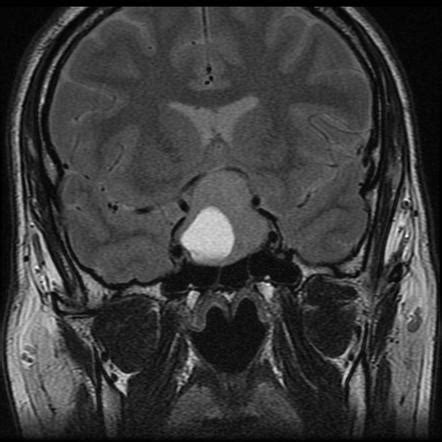 Rathke Cleft Cyst Radiology Reference Article Radiopaedia Org