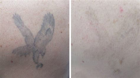 Tattooentfernung Behandlung Kosten Skinmed