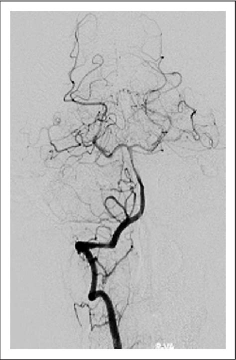 Figure 4 From Endovascular Treatment Of V3 Segment Vertebro Vertebral