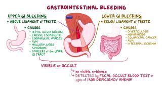 Esophageal Varices: What Are They, Causes, and More | Osmosis