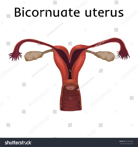 Vektor Stok Heartshaped Becornuate Uterus Womb Uterine Abnormalities