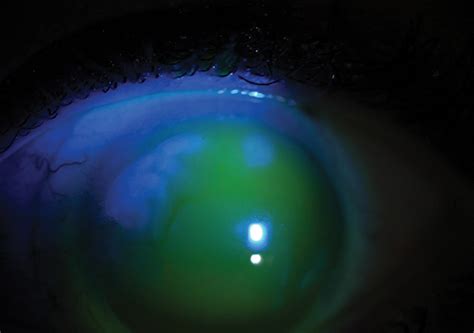 Treating Ocular Surface Disease With Scleral Lenses Modern Optometry