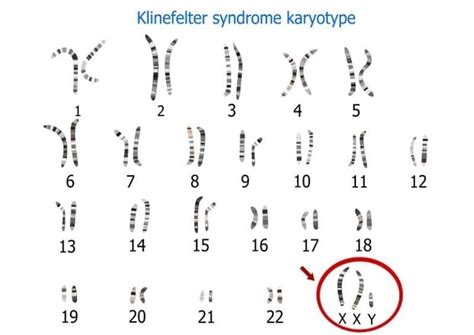 Male Infertility And Klinefelter Syndrome