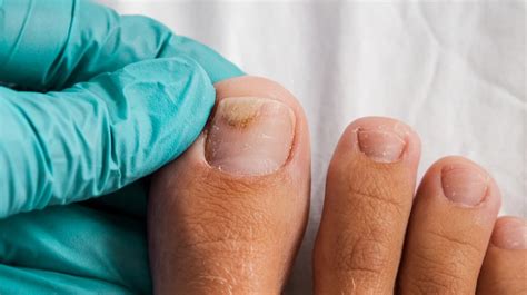 Onycholysis Causes Symptoms And Treatments