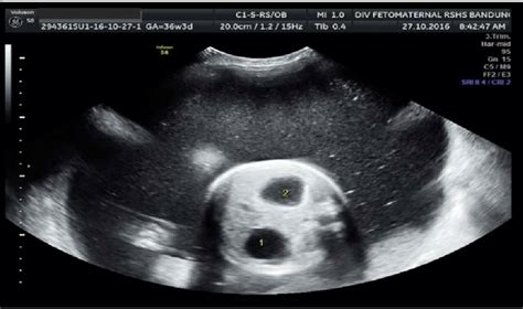 Duodenal Atresia With Double Bubble Transverse View Of The Fetal