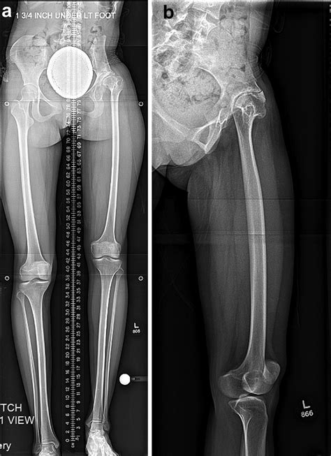 A And B Case 2 AP And Lateral Radiographs At Initial Presentation