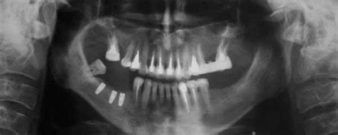 What are the Consequences of Jaw Bone Loss? - Munoz Family and Cosmetic ...