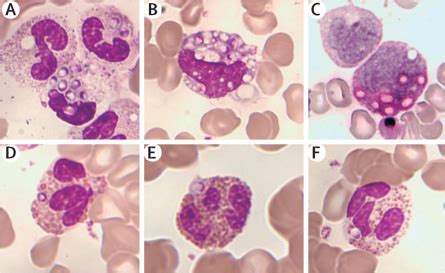 Yeast Phagocytosis By Eosinophils A Case Of Disseminated