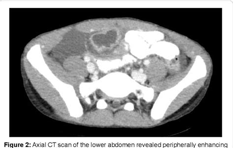 Figure 1 From Meckel Diverticulum In The Setting Of Acute Appendicitis