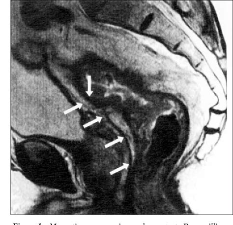 Figure From Pathological Evidence In Support Of Total Mesorectal