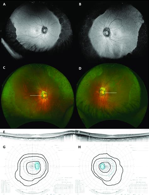 Wide Field Fundus Autofluorescent A B Pseudo Color C D Optical