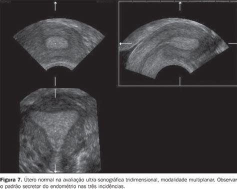 Scielo Brasil Ultra Sonografia Tridimensional Em Ginecologia