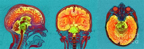 Brain Cancer Photograph By Simon Frasernewcastle Hospitals Nhs Trustscience Photo Library