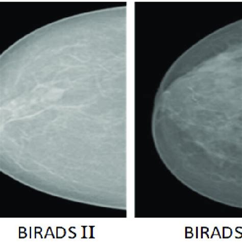 Mammogram images example of four BI-RADS breast density category... | Download Scientific Diagram