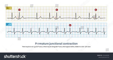 13 Ekg premature junctional Images, Stock Photos & Vectors | Shutterstock