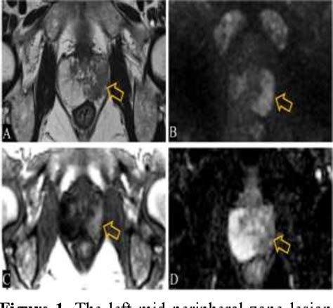 Figure 1 From The Efficacy Of Multiparametric Prostate Magnetic