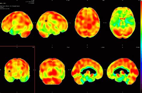 Nuclear Medicine Cerebral Perfusion Brain Single Photon Emission