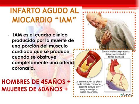 Ppt Infarto Agudo Al Miocardio Powerpoint Presentation Id4315168