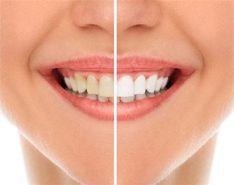 Impress Professional Teeth Whitening Impress