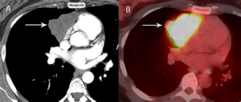 Frontiers Imaging Evaluation Of Thymoma And Thymic Carcinoma