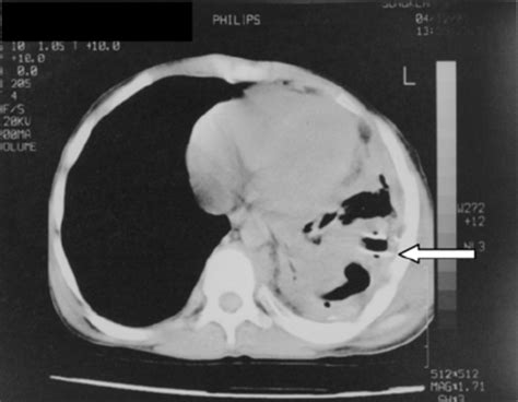 Fluid Around Lung Ct Scan