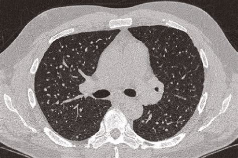 Why Silicosis Is On The Rise And What To Do About It Medical Republic