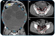 Scielo Brasil Giant Peritoneal Hydatid Cyst Causing Pelvic Venous