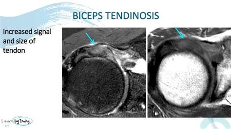 Mri Biceps Tendon Long Head Radedasia